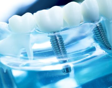 Implants dentaires-Clinique dentaire Famili-Dent à Granby, Plessisville et Sorel-Tracy