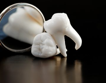 Dents de sagesse-Clinique dentaire Famili-Dent à Granby, Plessisville et Sorel-Tracy